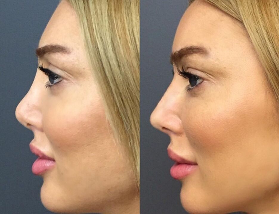 Plastic on the nose