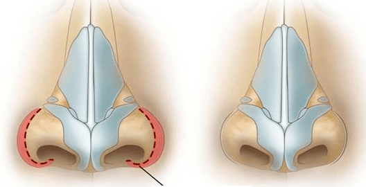 Reduction of the nostril
