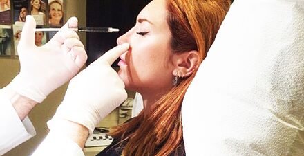 Rhinoplasty surgery with fillers