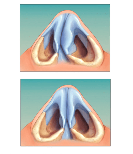 correct nasal septum