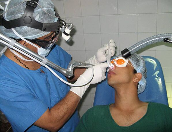 septum correction using laser scalpel