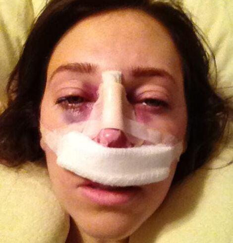 After surgery, a plaster bandage is applied to the nose