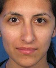 Irregular shape of the nose is a reason for plastic surgery