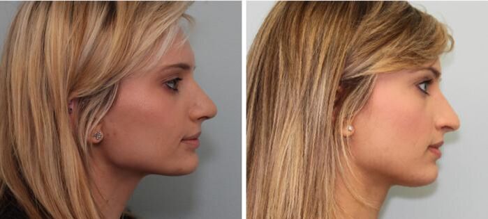 Results of rhinoplasty before and after