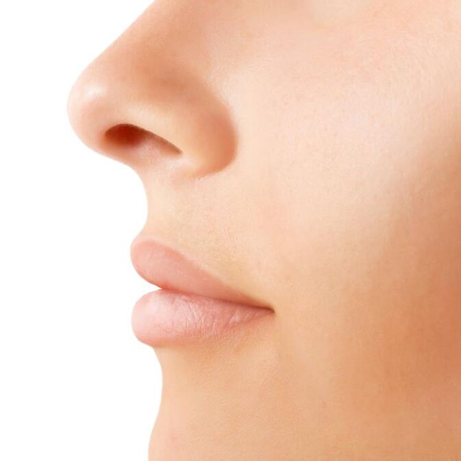result of open rhinoplasty
