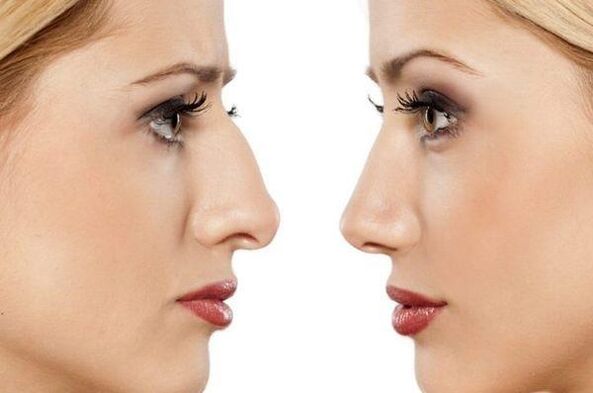 rhinoplasty of the nose to eliminate the hump