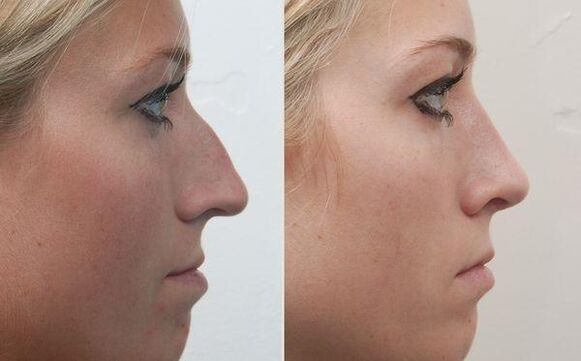 the result of nose rhinoplasty