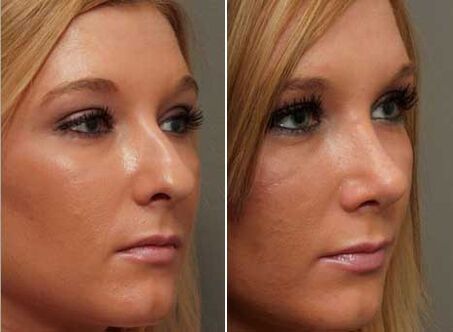 before and after nose rhinoplasty