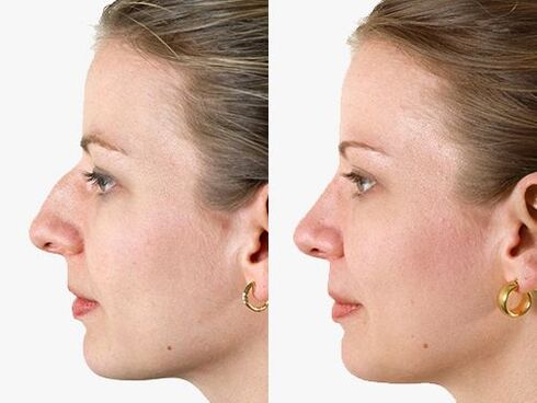 photo before and after rhinoplasticaplast
