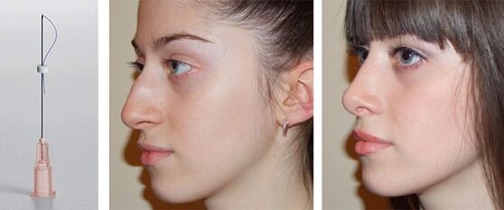 before and after rhinoplasty with mesophiles