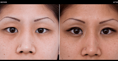 before and after eye surgery