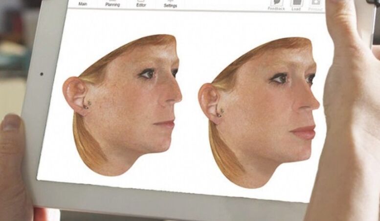 Computer modeling method of the nose before rhinoplasty
