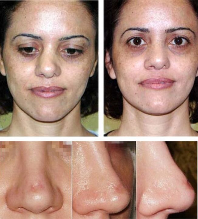 photo before and after rhinoplasty
