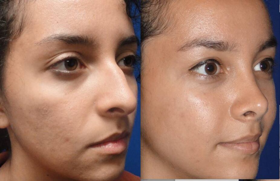 before and after photos of closed rhinoplasty