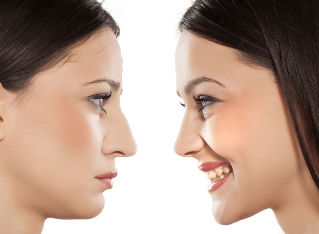 Rhinoplasty of the nose before and after