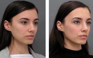 The girl in the before and after rhinoplasty of nose