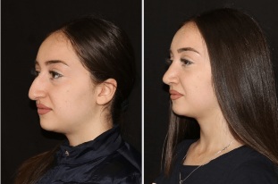 The result of the correction of the nose after a rhinoplasty