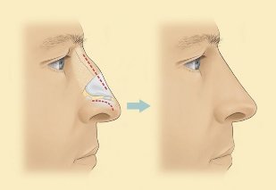 How to have a rhinoplasty