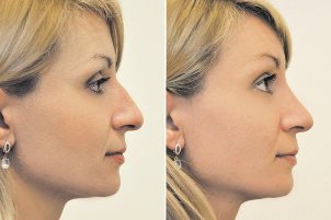 Non-surgical rhinoplasty, the photo before and after